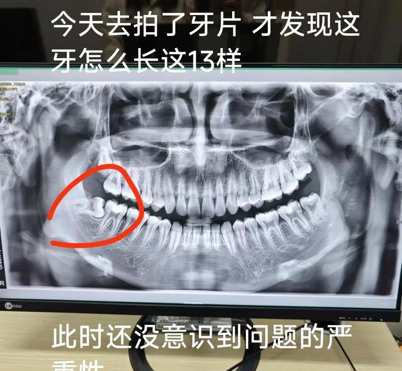 智齿生长情况与拔除问题（智齿生长方式及拔除的必要性）